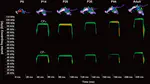 Development of the hyolaryngeal architecture in horseshoe bats: Insights into the evolution of the pulse generation for laryngeal echolocation